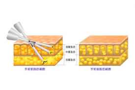 抽脂肪对身体有什么副作用 抽脂手术大概花多少钱